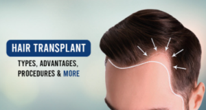 What is a hair transplant? Expense, profit, loss, how is it done?