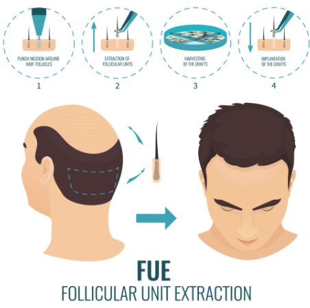 What is FUE technology?